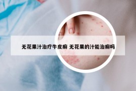 無花果汁治療牛皮癬 無花果的汁能治癬嗎