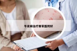 牛皮癬治療那家醫(yī)院好