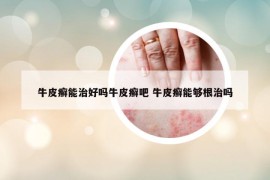 牛皮癬能治好嗎牛皮癬吧 牛皮癬能夠根治嗎