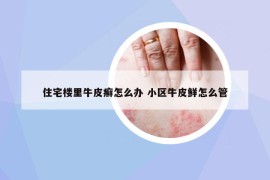住宅樓里牛皮癬怎么辦 小區(qū)牛皮鮮怎么管