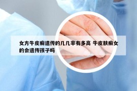 女方牛皮癬遺傳的幾幾率有多高 牛皮膚癬女的會(huì)遺傳孩子嗎