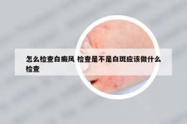 怎么檢查白癜風 檢查是不是白斑應該做什么檢查