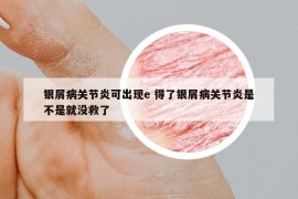 銀屑病關(guān)節(jié)炎可出現(xiàn)e 得了銀屑病關(guān)節(jié)炎是不是就沒救了