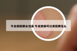 牛皮癬硫磺水泡澡 牛皮膚癬可以用硫磺皂么