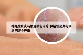 神經(jīng)性皮炎與銀屑病能治療 神經(jīng)性皮炎與銀屑病哪個(gè)嚴(yán)重