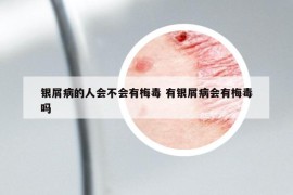 銀屑病的人會(huì)不會(huì)有梅毒 有銀屑病會(huì)有梅毒嗎