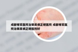 成都哪家醫(yī)院治銀屑病正規(guī)醫(yī)院 成都哪家醫(yī)院治銀屑病正規(guī)醫(yī)院好