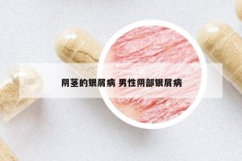 陰莖的銀屑病 男性陰部銀屑病