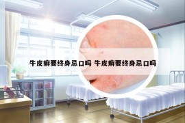 牛皮癬要終身忌口嗎 牛皮癬要終身忌口嗎