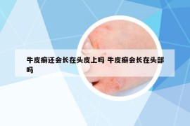 牛皮癬還會(huì)長在頭皮上嗎 牛皮癬會(huì)長在頭部嗎