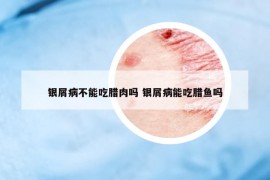 銀屑病不能吃臘肉嗎 銀屑病能吃臘魚嗎