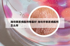 濰坊銀屑病醫(yī)院哪最好 濰坊市銀屑病醫(yī)院 怎么樣