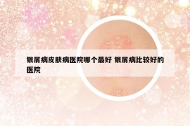 銀屑病皮膚病醫(yī)院哪個(gè)最好 銀屑病比較好的醫(yī)院