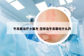 牛皮廨治療小偏方 怎樣治牛皮廨吃什么藥