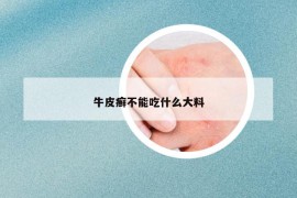 牛皮癬不能吃什么大料