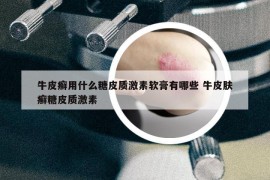 牛皮癬用什么糖皮質激素軟膏有哪些 牛皮膚癬糖皮質激素