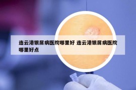 連云港銀屑病醫(yī)院哪里好 連云港銀屑病醫(yī)院哪里好點(diǎn)