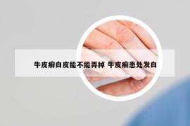 牛皮癬白皮能不能弄掉 牛皮癬患處發(fā)白