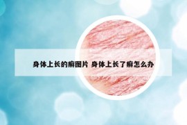 身體上長(zhǎng)的癬圖片 身體上長(zhǎng)了癬怎么辦