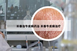 長春治牛皮癬藥浴 長春牛皮癬治療