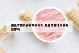 強(qiáng)直脊椎炎會有牛皮癬嗎 強(qiáng)直性脊柱炎會有皮疹嗎