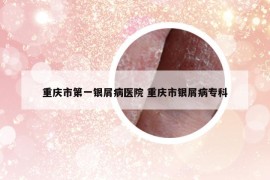 重慶市第一銀屑病醫(yī)院 重慶市銀屑病?？? /></a>		
		</figure>

		<header class=