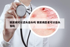 銀屑病可以燙頭染頭嗎 銀屑病患者可以染頭發(fā)嗎
