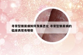 尋常型銀屑病如何發(fā)展惡化 尋常型銀屑病的臨床表現(xiàn)有哪些