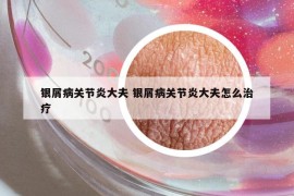 銀屑病關(guān)節(jié)炎大夫 銀屑病關(guān)節(jié)炎大夫怎么治療
