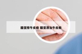 醋蛋擦牛皮癬 醋蛋液治牛皮癬