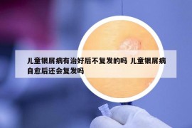兒童銀屑病有治好后不復發(fā)的嗎 兒童銀屑病自愈后還會復發(fā)嗎