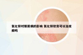 氧化鋅對(duì)銀屑病的影響 氧化鋅軟膏可以治皮癬嗎