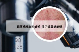 銀屑病喝咖啡好嗎 得了銀屑病能喝