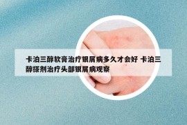 卡泊三醇軟膏治療銀屑病多久才會好 卡泊三醇搽劑治療頭部銀屑病觀察