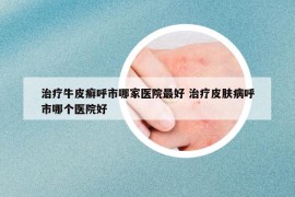 治療牛皮癬呼市哪家醫(yī)院最好 治療皮膚病呼市哪個醫(yī)院好