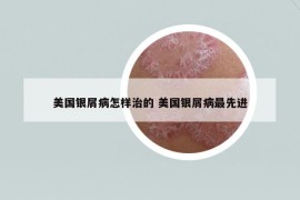 美國銀屑病怎樣治的 美國銀屑病最先進