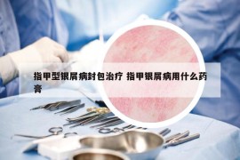 指甲型銀屑病封包治療 指甲銀屑病用什么藥膏