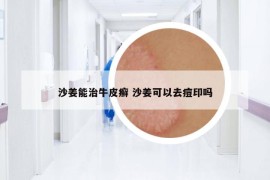 沙姜能治牛皮癬 沙姜可以去痘印嗎