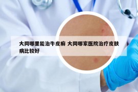 大同哪里能治牛皮癬 大同哪家醫(yī)院治療皮膚病比較好