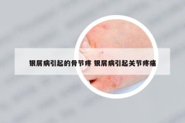 銀屑病引起的骨節(jié)疼 銀屑病引起關(guān)節(jié)疼痛