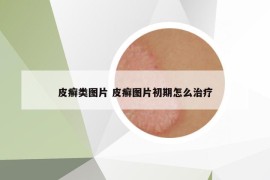 皮癬類圖片 皮癬圖片初期怎么治療