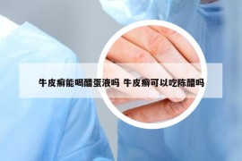 牛皮癬能喝醋蛋液?jiǎn)?牛皮癬可以吃陳醋嗎