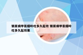 銀屑病甲氨蝶呤吃多久起效 銀屑病甲氨蝶呤吃多久起效果