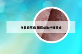 代縣銀屑病 銀屑病治療哪里好