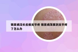 銀屑病沒長皮癬關(guān)節(jié)疼 銀屑病發(fā)展到關(guān)節(jié)疼了怎么辦