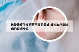 長沙治療牛皮癬醫(yī)院哪家最好 長沙治療皮膚病的權(quán)威專家