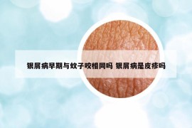 銀屑病早期與蚊子咬相同嗎 銀屑病是皮疹嗎