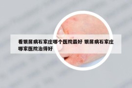 看銀屑病石家莊哪個醫(yī)院最好 銀屑病石家莊哪家醫(yī)院治得好