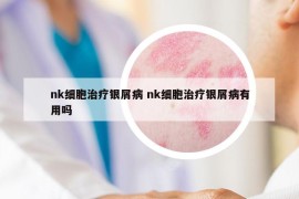 nk細(xì)胞治療銀屑病 nk細(xì)胞治療銀屑病有用嗎