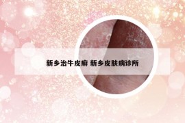 新鄉(xiāng)治牛皮癬 新鄉(xiāng)皮膚病診所